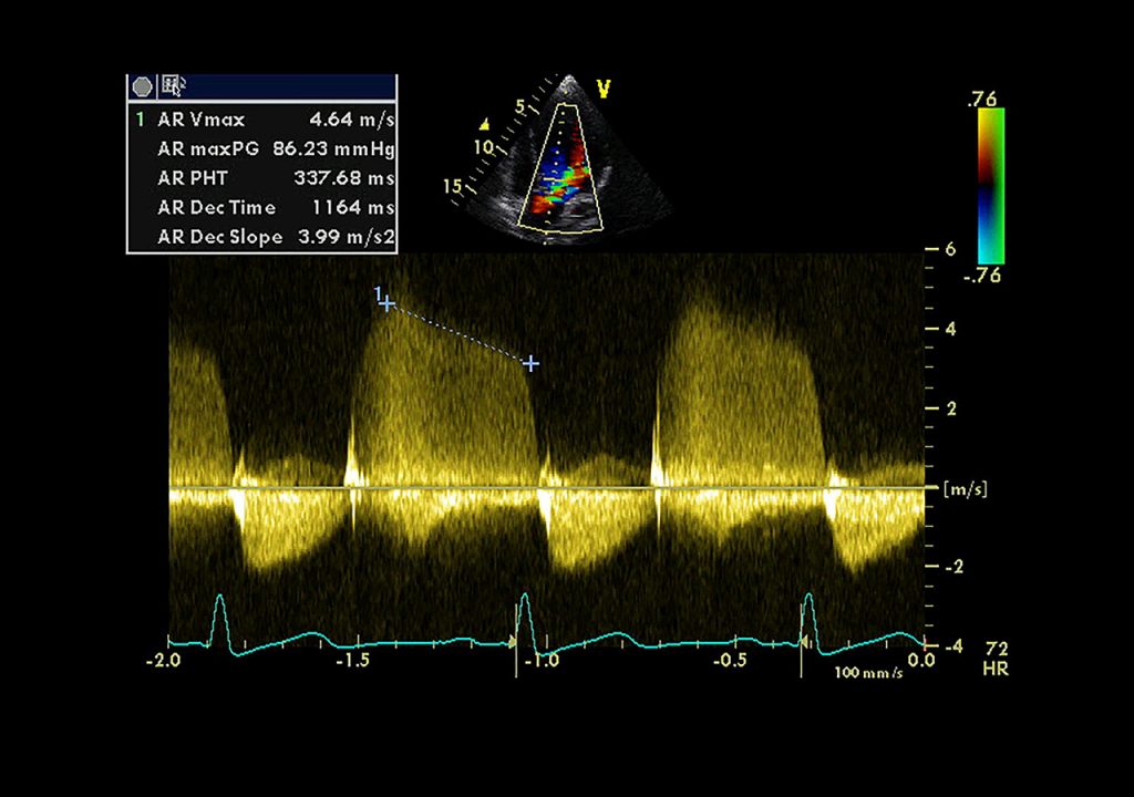 Effet doppler